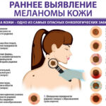12 мая в ТОГБУЗ «ГКБ № 4 г Тамбова» был проведен скрининг по раннему выявлению меланомы